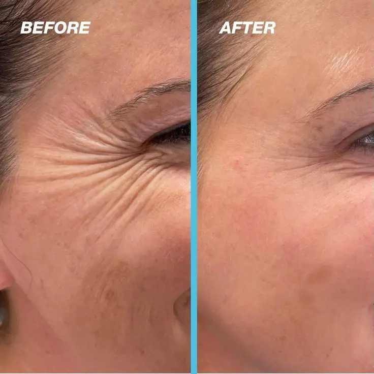 Botox Before and After (1)