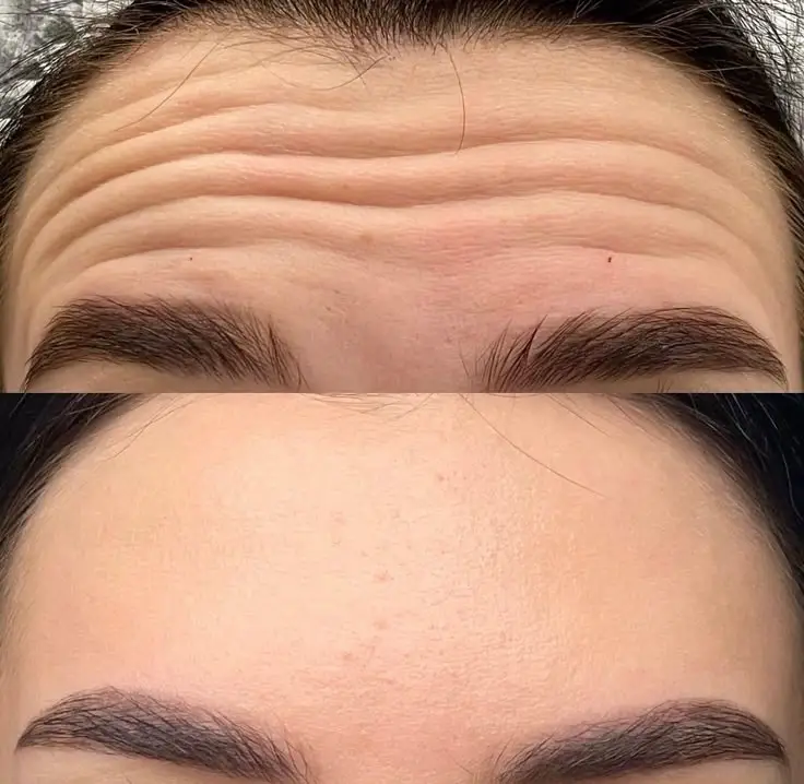 Botox Before and After (2)