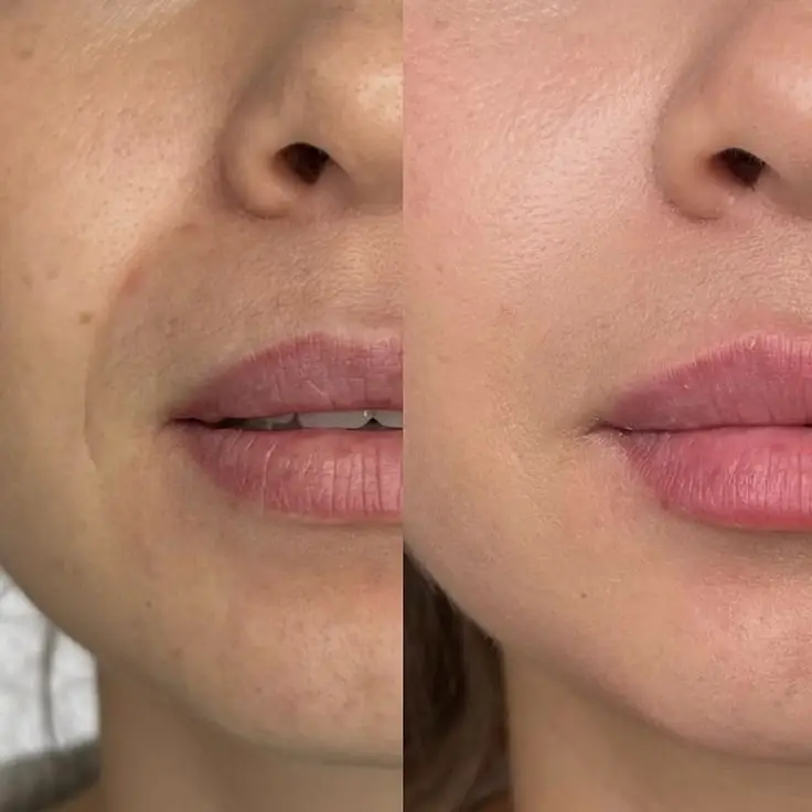 Botox Before and After (3)