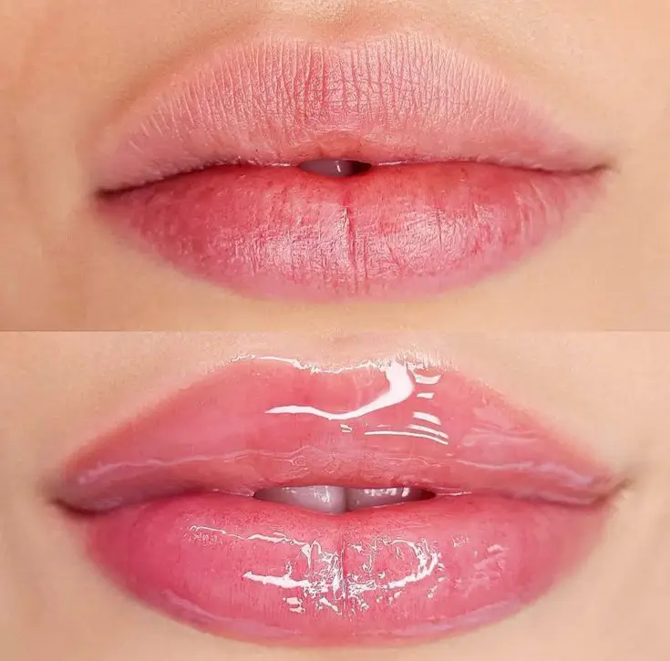 Filler Before and After (1)