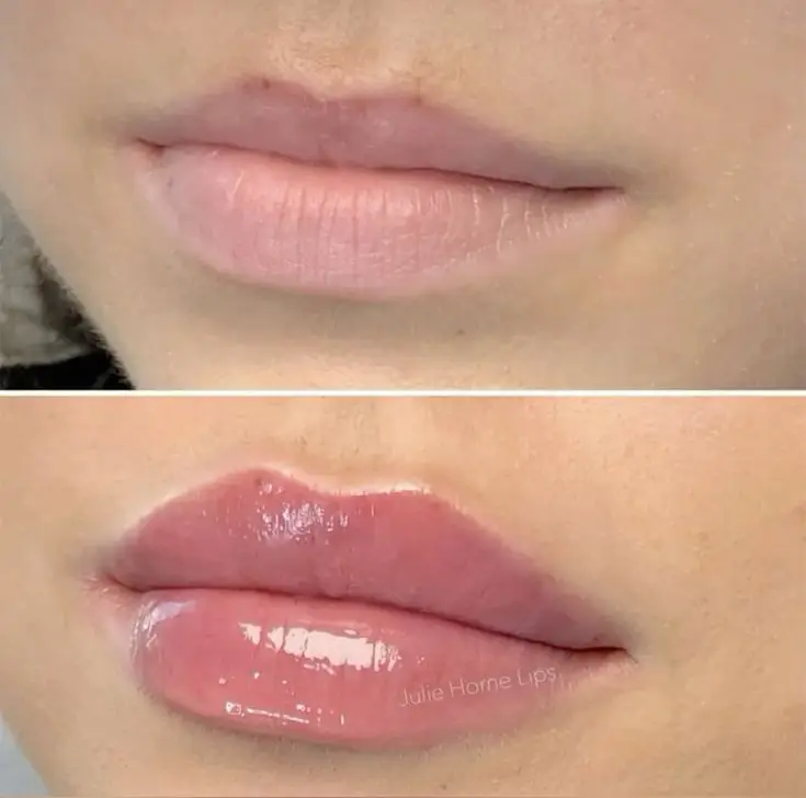 Filler Before and After