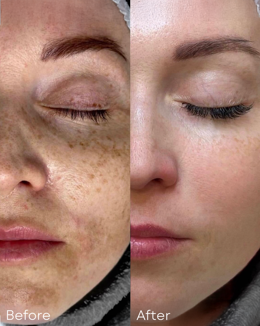 BBL-HEROic-Before-After-Face-Closeup