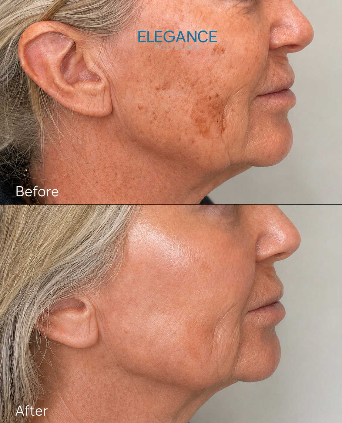 BBL-HEROic-Before-After-Face-Profile